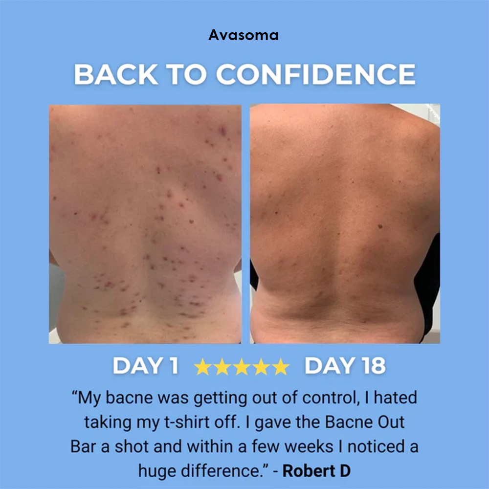 🌿 Avasoma® Natural Botanical Treatment Bar | Advanced Acne & Scar Remover for Back & Body ✨