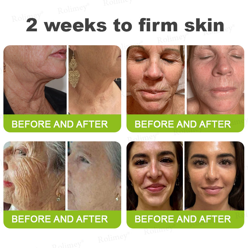 Made and shipped from the UK 🏉Rolimey® Botox & Vita-A Retinol Shot Wrinkle-Lift Tightening cream - Last Day Promotion 70% OFF