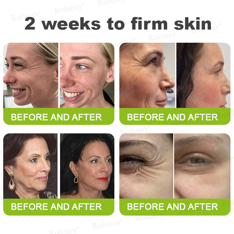 Made and shipped from the UK 🏉Rolimey® Botox & Vita-A Retinol Shot Wrinkle-Lift Tightening cream - Last Day Promotion 70% OFF