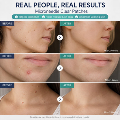 🦄 Target Unwanted Skin Tags With One Simple Patch ✨