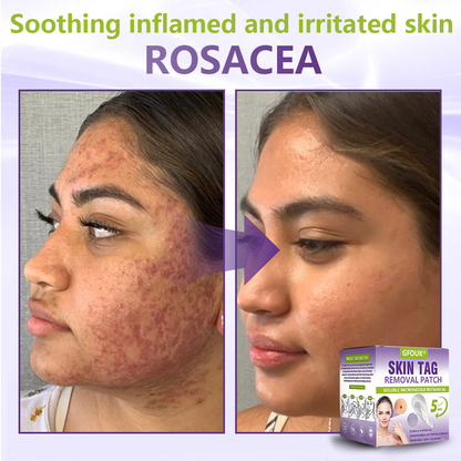 GFOUK® Soluble Microneedle Botanical Skin Tag Removal Patch🏉