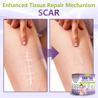GFOUK® Soluble Microneedle Botanical Skin Tag Removal Patch🏉
