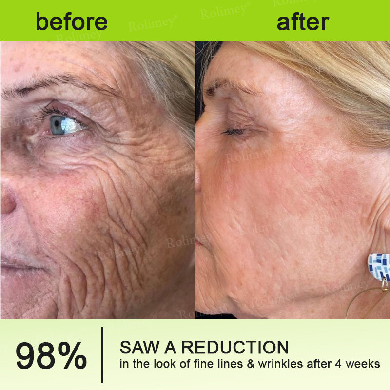 Made and shipped from the UK 🏉Rolimey® Botox & Vita-A Retinol Shot Wrinkle-Lift Tightening cream - Last Day Promotion 70% OFF