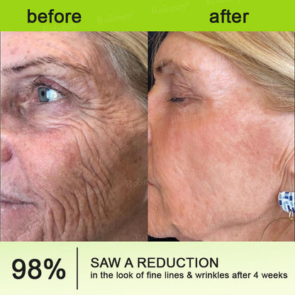 Made and shipped from the UK 🏉Rolimey® Botox & Vita-A Retinol Shot Wrinkle-Lift Tightening cream - Last Day Promotion 70% OFF