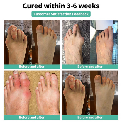 🏅DOCTIA® Relief Botanical Bunion Comfort Patcht👠💃（Physical Stretch Support + Botanical Comfort Formula)