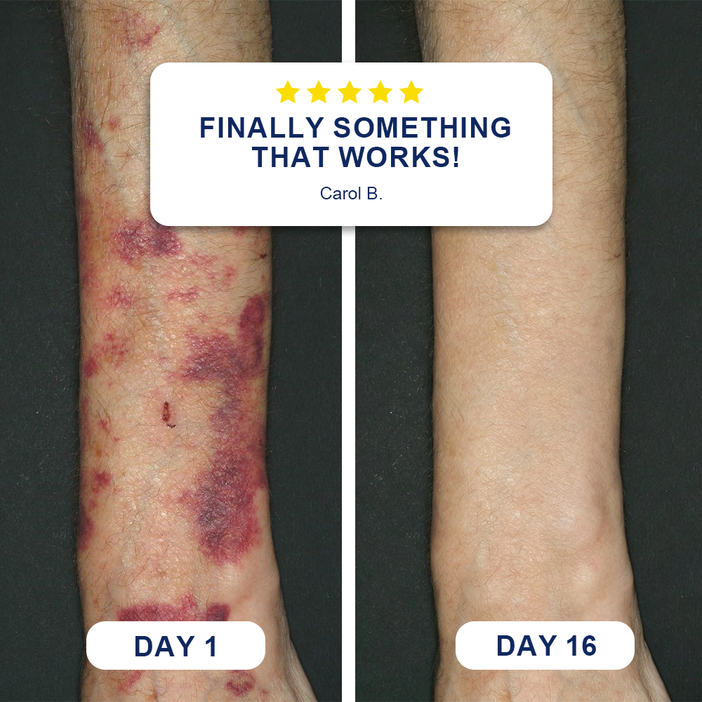 🏉Evolvion® Bruise Repair & Skin-Strengthening Cream