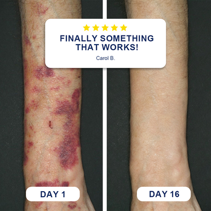 🏉Evolvion® Bruise Repair & Skin-Strengthening Cream
