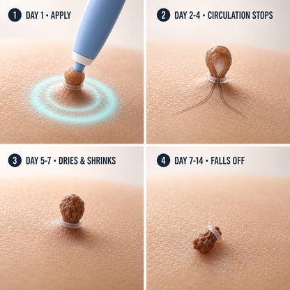 GFOUK®Skintag Removal Kit