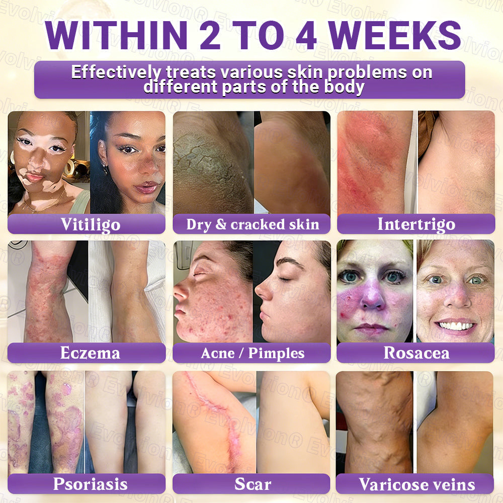 Made and Shipped from UK🏉👨‍⚕️Evolvion® Biotin 10-in-1 All-in-One Barrier Repair Cream - Last Day Promotion: 50% OFF