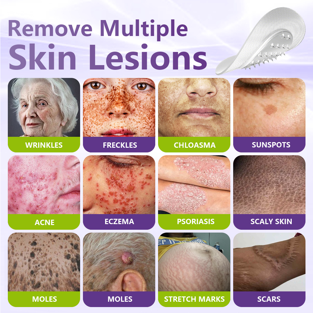 GFOUK® Soluble Microneedle Botanical Skin Tag Removal Patch🏉