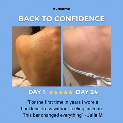 🌿 Avasoma® Natural Botanical Treatment Bar | Advanced Acne & Scar Remover for Back & Body ✨