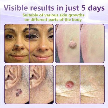 GFOUK® Soluble Microneedle Botanical Skin Tag Removal Patch🏉