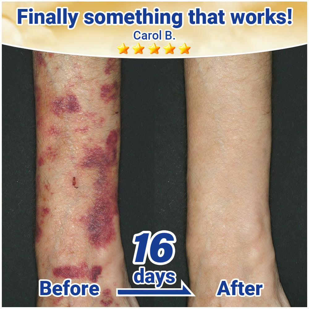 🏉Evolvion® Senile Purpura, Bruise & Fragile Skin Repair Cream💛