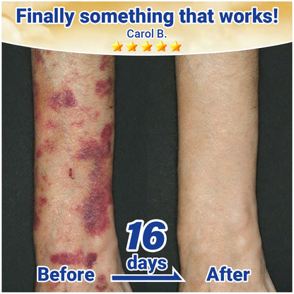 🏉Evolvion® Senile Purpura, Bruise & Fragile Skin Repair Cream💛