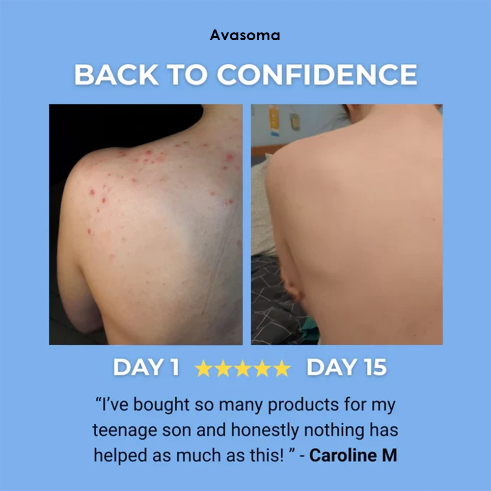 🌿 Avasoma® Natural Botanical Treatment Bar | Advanced Acne & Scar Remover for Back & Body ✨