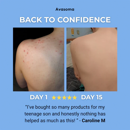 🌿 Avasoma® Natural Botanical Treatment Bar | Advanced Acne & Scar Remover for Back & Body ✨