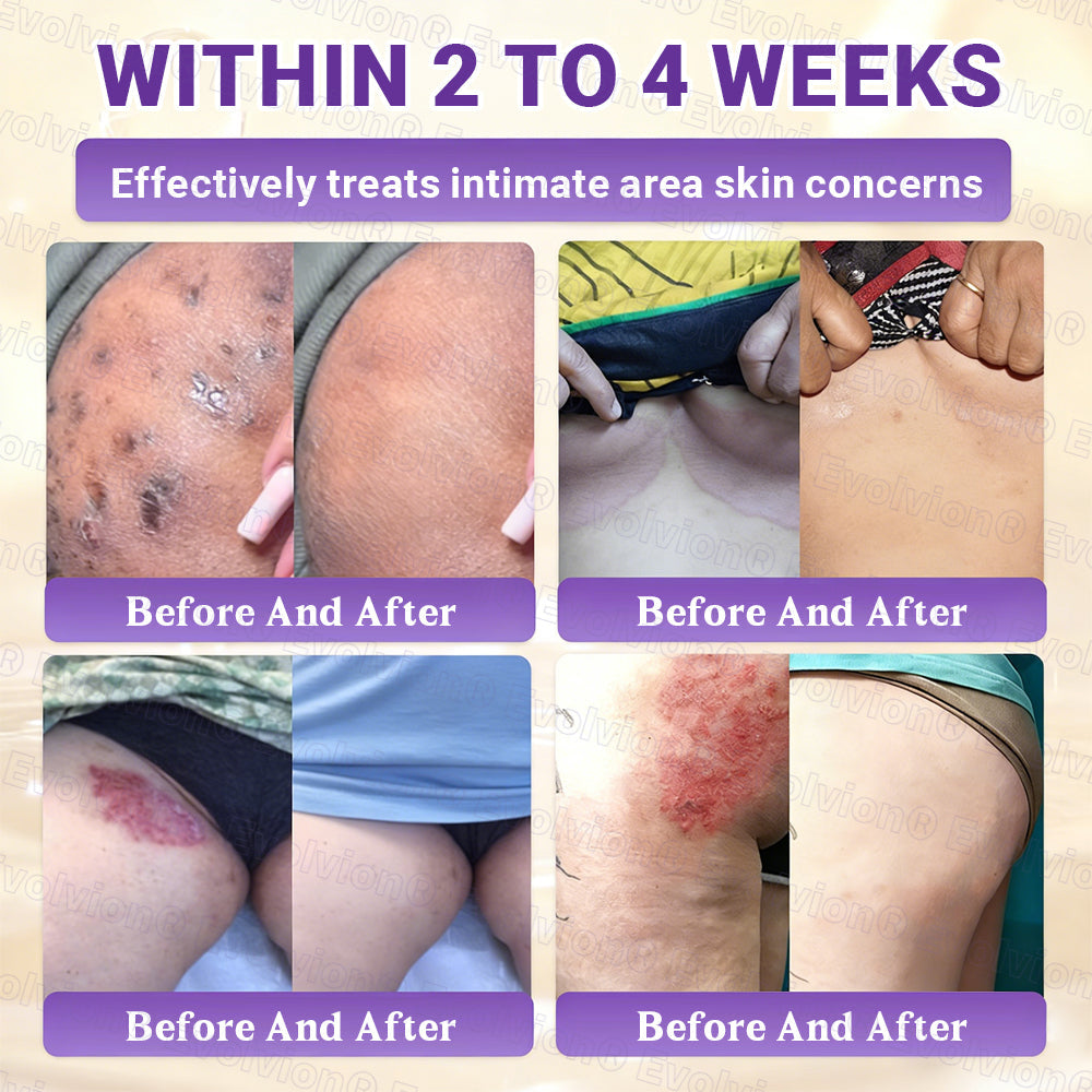 Made and Shipped from UK🏉👨‍⚕️Evolvion® Biotin 10-in-1 All-in-One Barrier Repair Cream - Last Day Promotion: 50% OFF