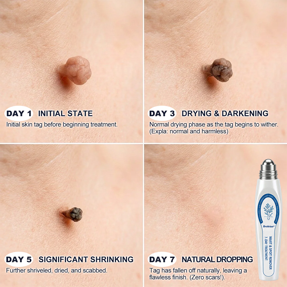 Made and Shipped from UK ✨Evolvion® 𝟕-𝐃𝒂𝘆 𝐒𝗸𝐢𝐧 𝐓𝒂𝗴 & 𝐒𝐩𝙤𝐭 𝐄𝐫𝒂𝐬𝙚𝐫 Painless & Scar-Free Advanced Imperfection Remova𝗜 Ro𝗜𝗜erba𝗜𝗜 Pen ❤️