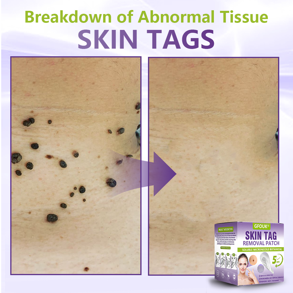 GFOUK® Soluble Microneedle Botanical Skin Tag Removal Patch🏉