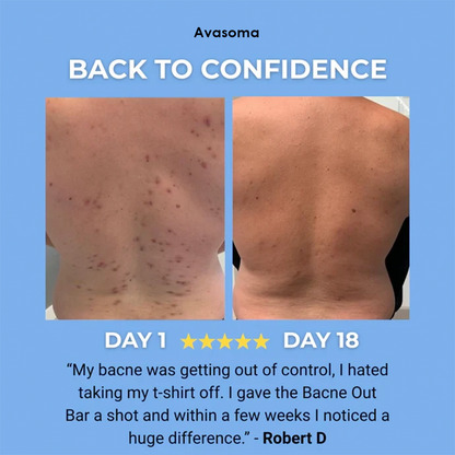 🌿 Avasoma® Natural Botanical Treatment Bar | Advanced Acne & Scar Remover for Back & Body ✨