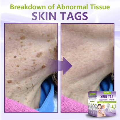 GFOUK® Soluble Microneedle Botanical Skin Tag Removal Patch🏉