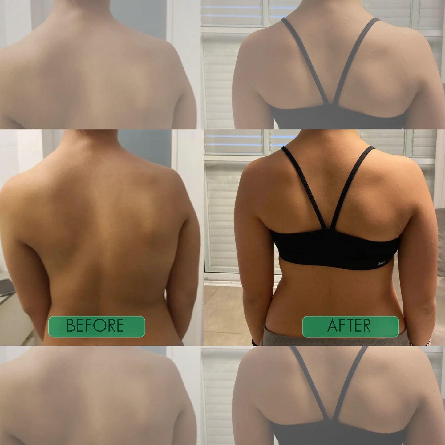 🧍‍♂️Avasoma® | Professional Posture Corrector.Discreetly invisible under clothes for lasting spinal health. Start standing better! 💎💪