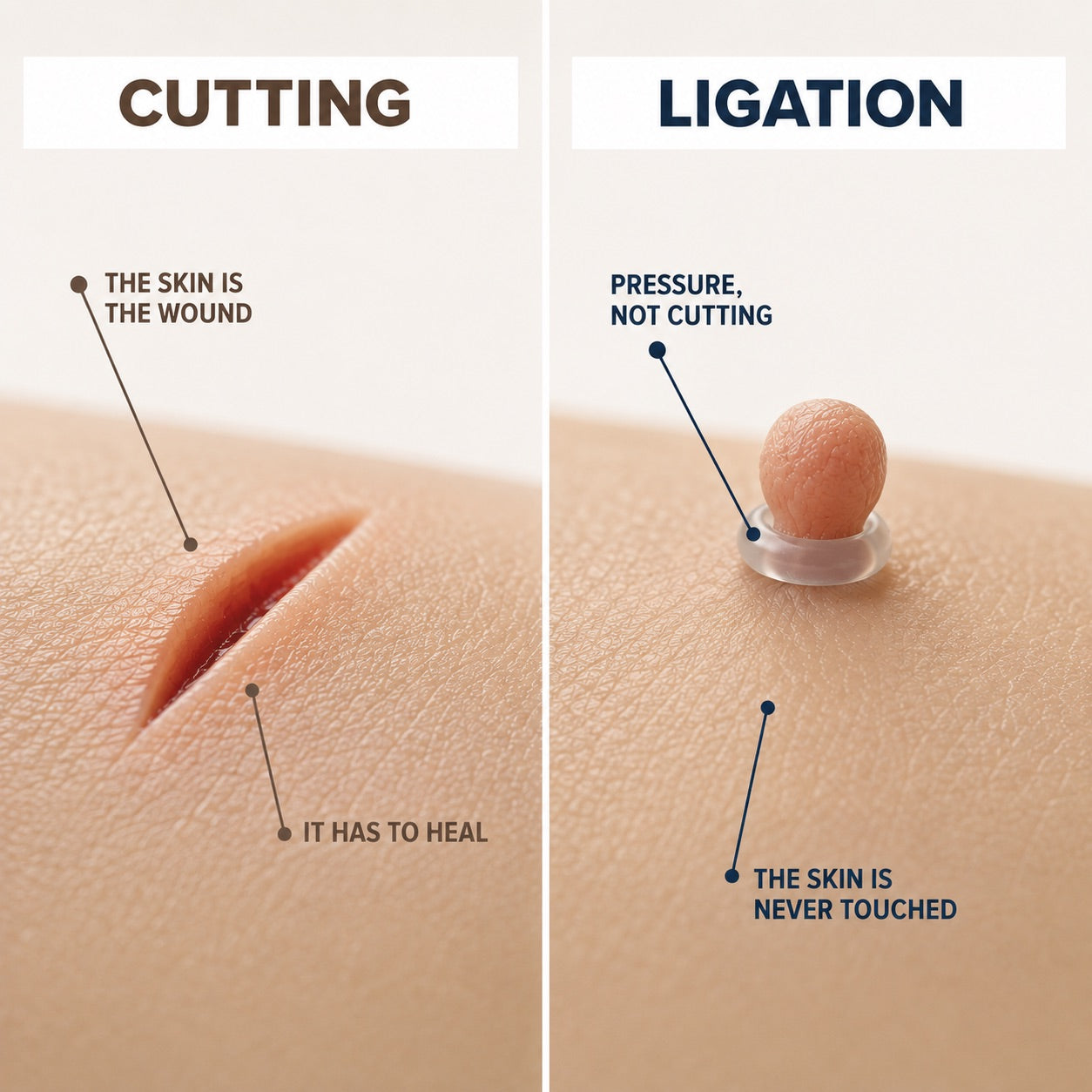 GFOUK®Skintag Removal Kit