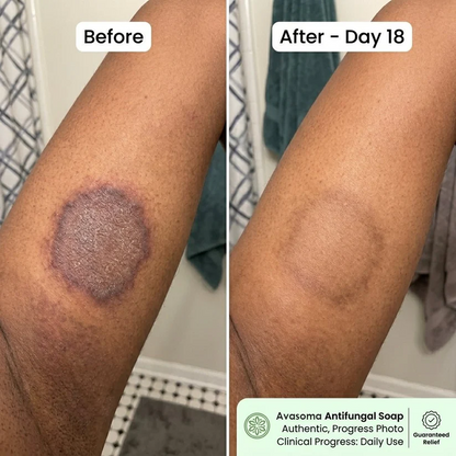 🦵Avasoma® Multi-Purpose Antifungal Bar: One Solution for Feet, Body & Persistent Itch