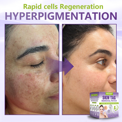 GFOUK® Soluble Microneedle Botanical Skin Tag Removal Patch🏉