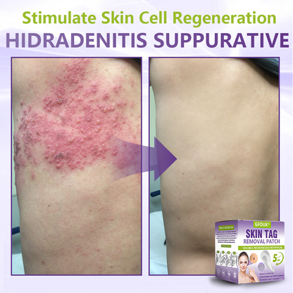 GFOUK® Soluble Microneedle Botanical Skin Tag Removal Patch🏉