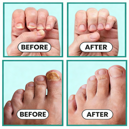 Avasoma®| Deeply eliminate fungus for flawless, clear nails💎🏉
