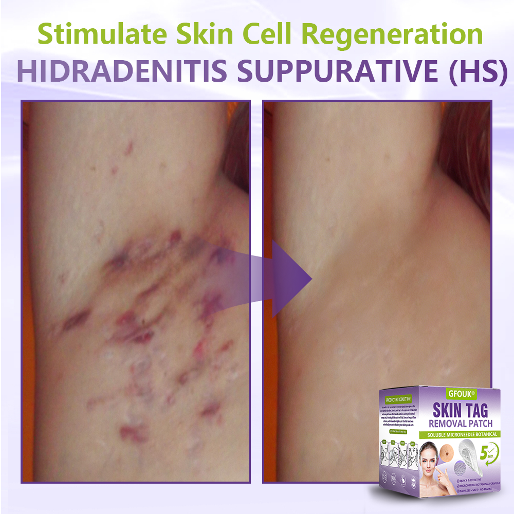 GFOUK® Soluble Microneedle Botanical Skin Tag Removal Patch🏉