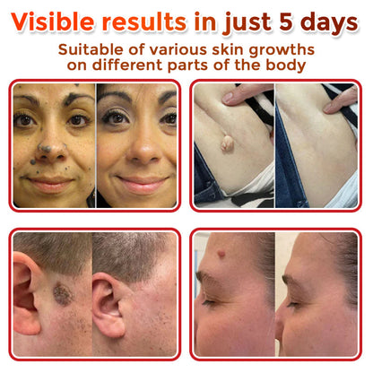 🏉GFOUK® MicroNeedle Botanic Skin Tag Removal Patch 🇬🇧 UK Stock & Fast Delivery