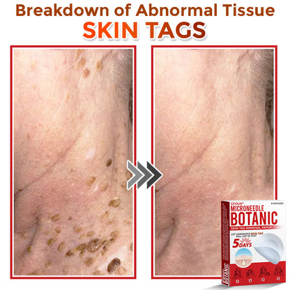 🏉GFOUK® MicroNeedle Botanic Skin Tag Removal Patch 🇬🇧 UK Stock & Fast Delivery
