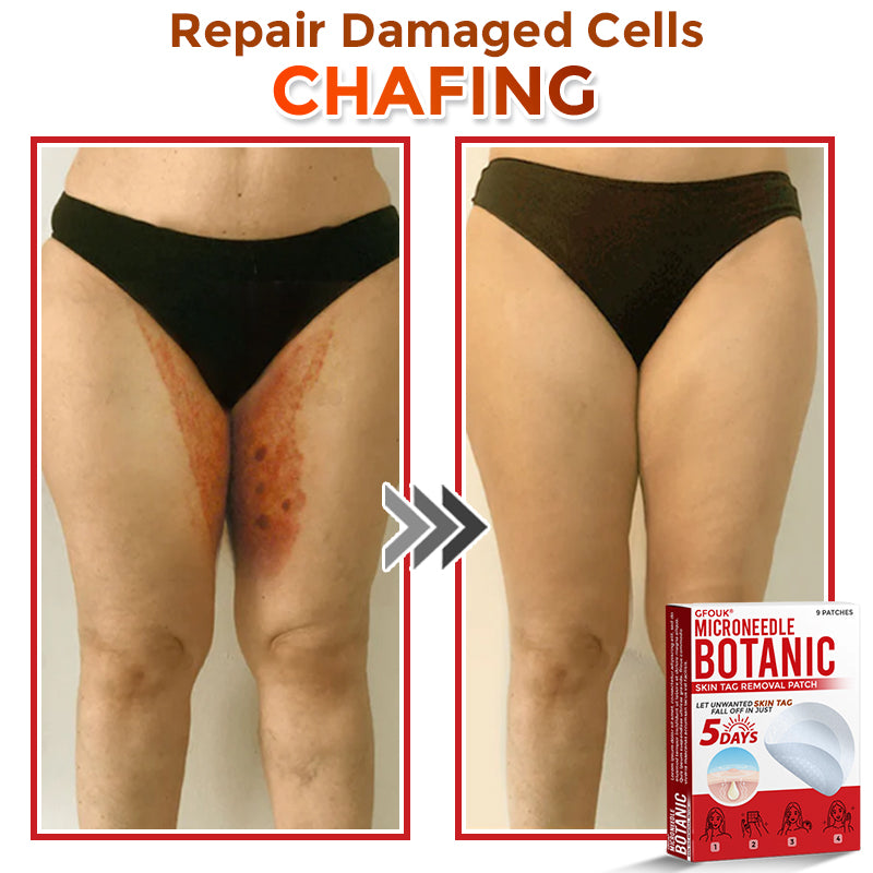 🏉GFOUK® MicroNeedle Botanic Skin Tag Removal Patch 🇬🇧 UK Stock & Fast Delivery
