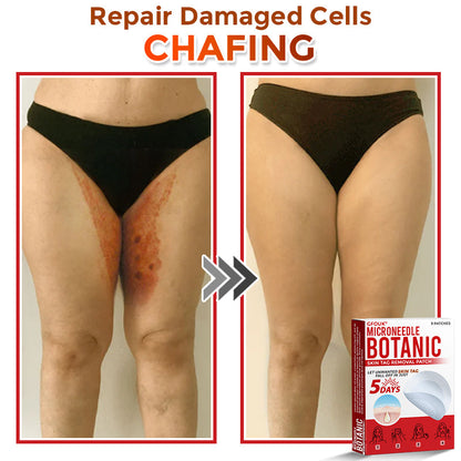 🏉GFOUK® MicroNeedle Botanic Skin Tag Removal Patch 🇬🇧 UK Stock & Fast Delivery