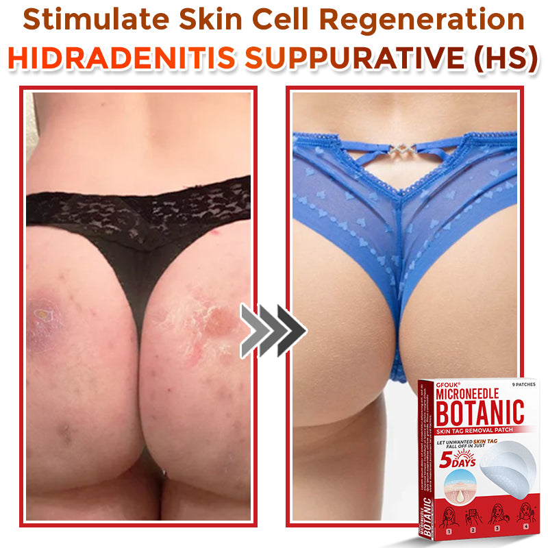 🏉GFOUK® MicroNeedle Botanic Skin Tag Removal Patch 🇬🇧 UK Stock & Fast Delivery
