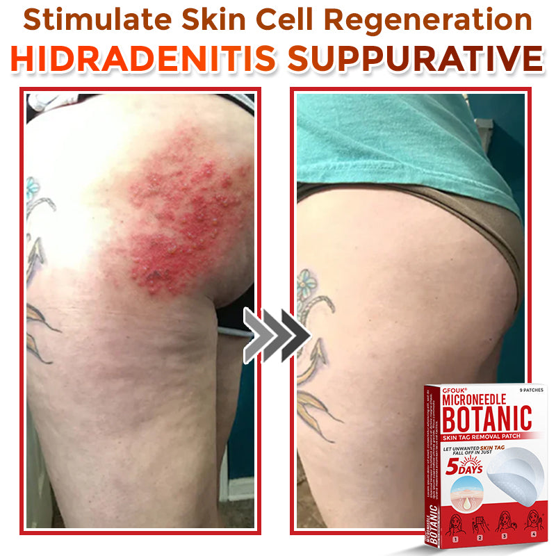 🏉GFOUK® MicroNeedle Botanic Skin Tag Removal Patch 🇬🇧 UK Stock & Fast Delivery