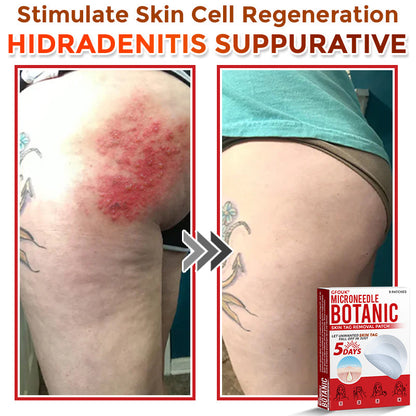 🏉GFOUK® MicroNeedle Botanic Skin Tag Removal Patch 🇬🇧 UK Stock & Fast Delivery