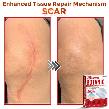 🏉GFOUK® MicroNeedle Botanic Skin Tag Removal Patch 🇬🇧 UK Stock & Fast Delivery
