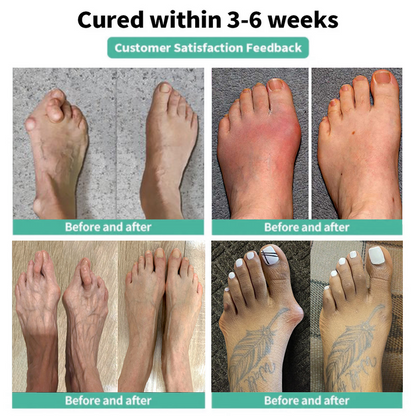 🏅DOCTIA® Relief Botanical Bunion Comfort Patcht👠💃（Physical Stretch Support + Botanical Comfort Formula)