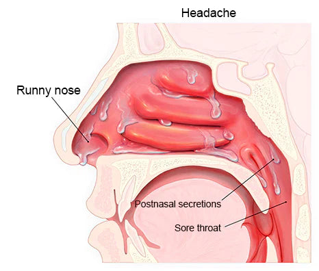 Avasoma® | Advanced 660nm Nasal Therapy Instant Relief for Allergies, Sinusitis & Congestion