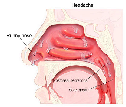 Avasoma® | Advanced 660nm Nasal Therapy Instant Relief for Allergies, Sinusitis & Congestion