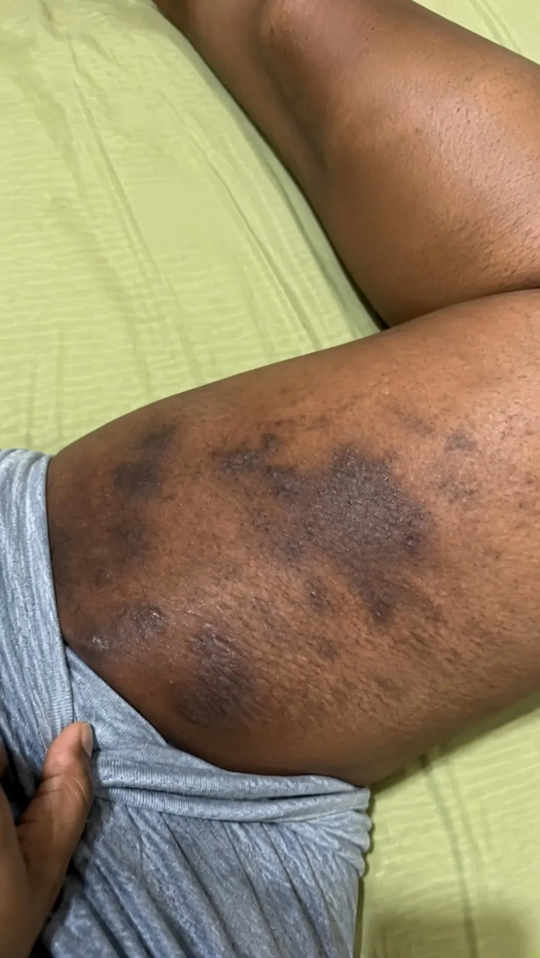 User-supplied body-area pigmentation image before comparison